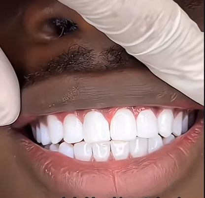 Sourire Éclatant : Le Correcteur de Couleur Dentaire Violet