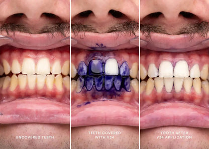 Sourire Éclatant : Le Correcteur de Couleur Dentaire Violet